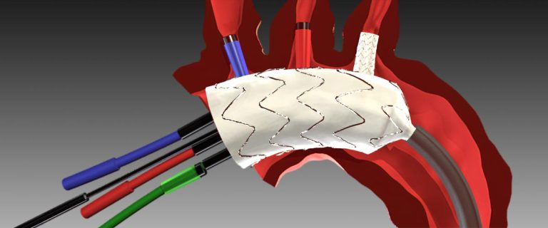 心脏支架手术动画 · Animation to  Heart Stent Operations (2008)